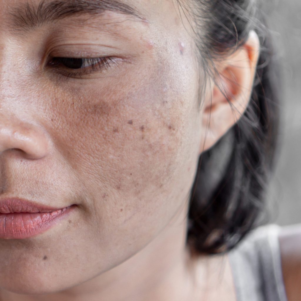 Pigmentation | Mizu