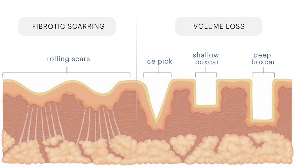 Radiofrequency Microneedling - Fibrotic Scarring vs Volume Loss | Mizu