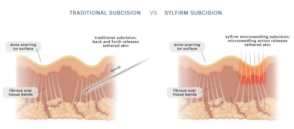 Radiofrequency Microneedling - Traditional Subcision vs Sylfirm Subcision | Mizu