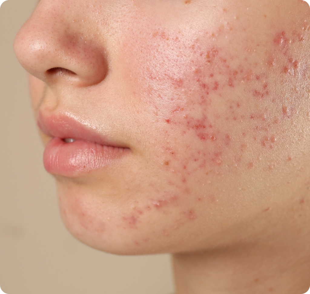 Acne - Close up Face Skin Acne | Mizu