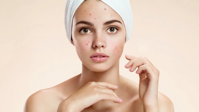 All About Acne | Mizu