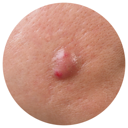 Acne - Cystic Acne | Mizu