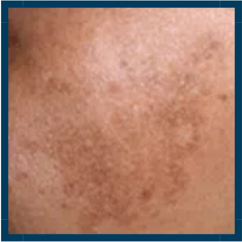 Dermal Pigmentation | Mizu