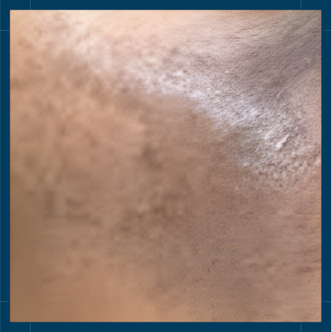 Skin Pigmentation - Nebus of Ota | Mizu