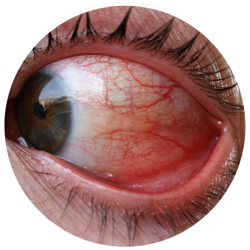 Rosacea - Eye Irritation | Mizu