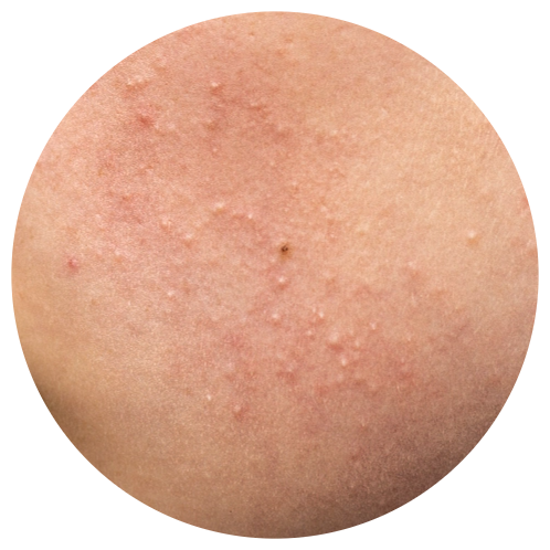 Acne - Fungal Acne | Mizu