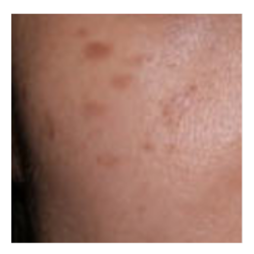 Skin Pigmentation - Horis Nevus | Mizu