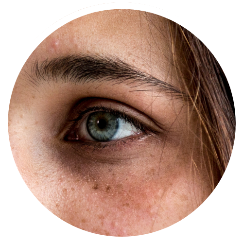 Dark Circles Concerns_Mixed Issues | Mizu