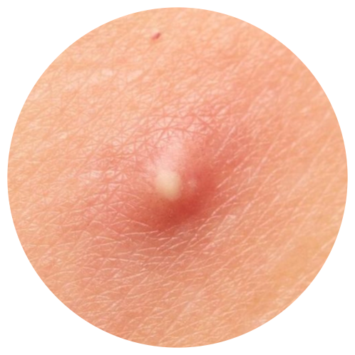 Acne - Pustules | Mizu