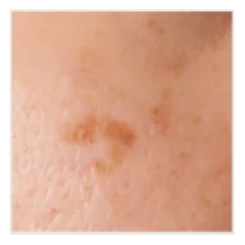 Skin Pigmentation - Sun Spots | Mizu