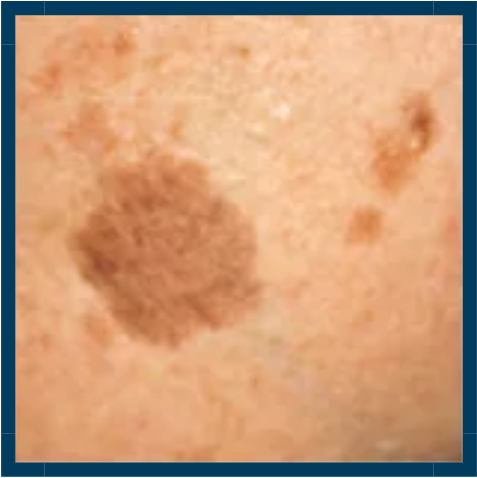 Skin Pigmentation - Superficial | Mizu