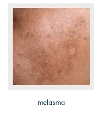 Skin Pigmentation | Mizu