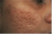 All About Acne | Mizu
