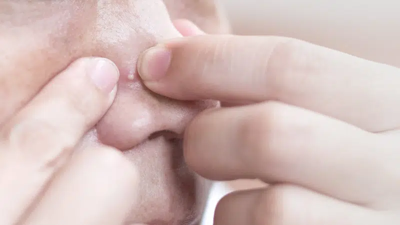 Acne Extraction | Mizu