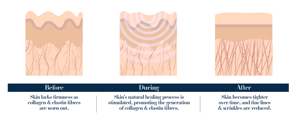 Collagen Stimulation By Energy Based Treatment | Mizu