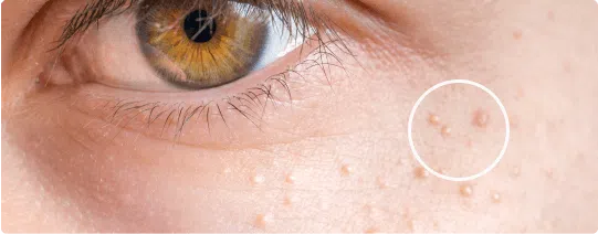 Mole, Milia & Skin Tag Removal | Mizu