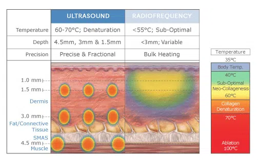 HIFU Ultrasound vs Radiofrequency | Mizu