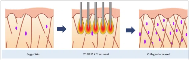 Radiofrequency Microneeding - Before & After Treatment | Mizu
