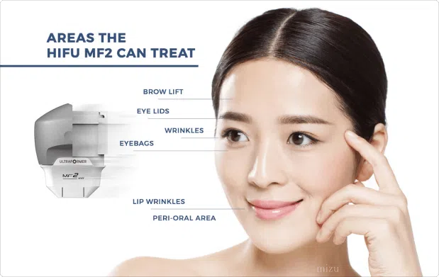 HIFU Eye - Areas the HIFU MF2 Can Treat | Mizu