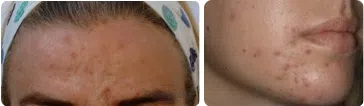 All About Acne | Mizu