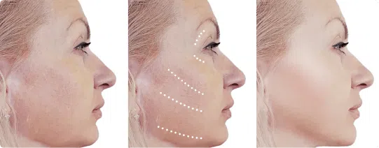 Chin Fillers | Mizu
