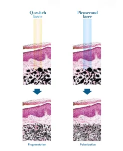 Q-switched Laser vs Picosecond Laser | Mizu