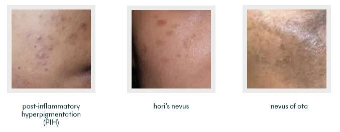Types of Skin Pigmentation | Mizu