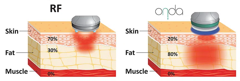 Onda Coolwaves Body Sculpting: RF vs Coolwaves Comparison | Mizu