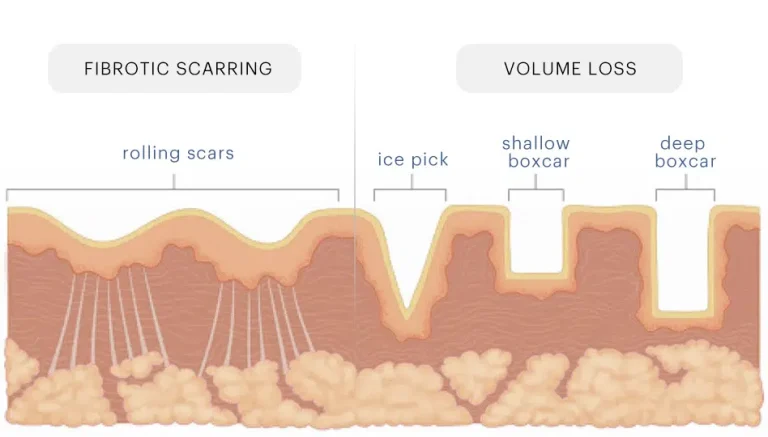 Acne Scarring Treatments: Fibrotic Scarring vs Volume Loss | Mizu
