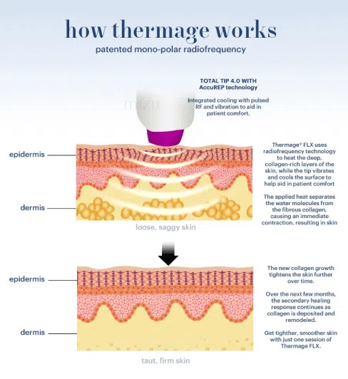 Thermage FLX Non-Surgical Skin Tightening - How Thermage Works | Mizu