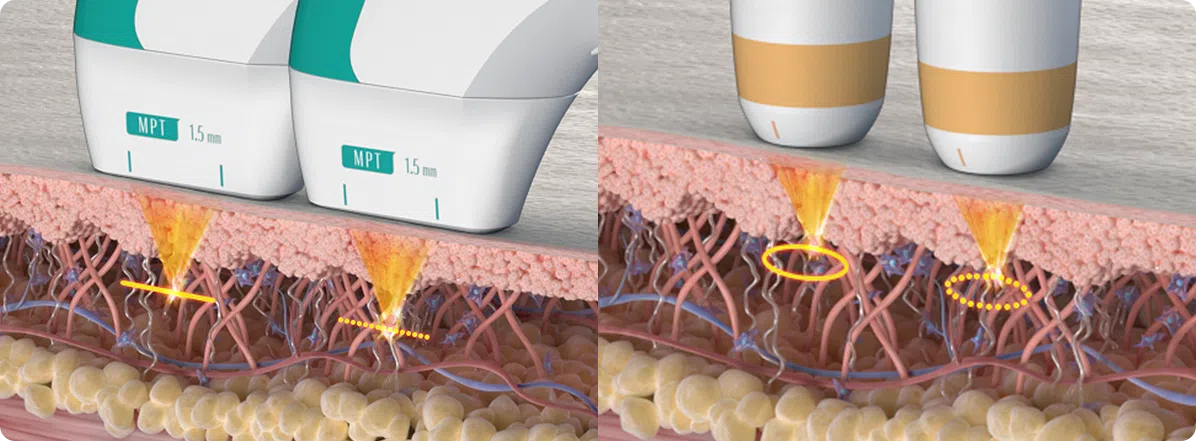 Ultraformer MPT handpiece line | Mizu